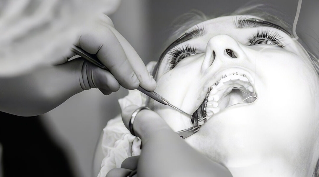 Tandbro behandling hos Tandlægerne ved Nyhavn: Alt om tandbroer og deres fordele